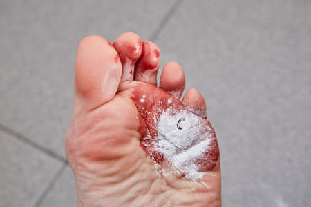 Laser removal of wart from the foot. White medicine powder.
