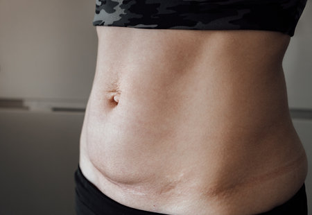 Scar on the skin. Abdomen of woman after the child birth by Cesarean section. Stretch marks after pregnancy. Navel hernia. White line diastasis. close-up. Lymph flow violation and fluid stagnation.の写真素材