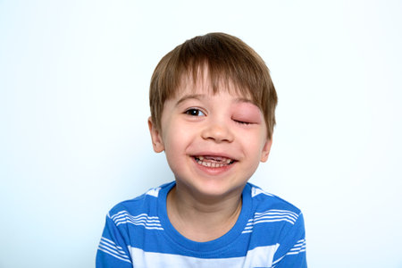 A boy with swollen eye from insect bite. Quincke edema. Portrait of Caucasian appearance child looking at the camera. studio background. isolated. face of allergic person. copyspace. studio. Allergy.の写真素材