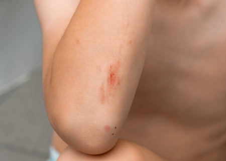 Wounded elbow of the child. Abrasion on the cubit of kid close-up after the fall. A scratch with blood. Body trauma.の写真素材