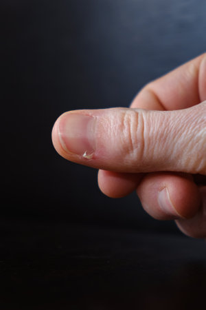 Bleeding hangnail of a female hand on dark background close-up. Ill injury. Ripped off skin. Concept...