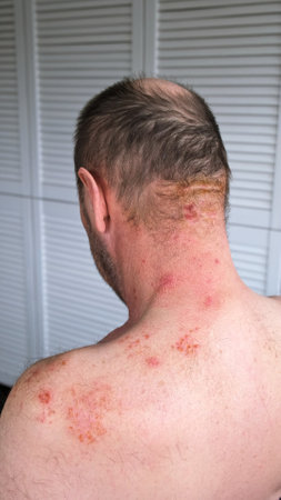 Skin lesion symptom in Shingles or Herpes zoster in person. Viral disease Varicella virus. Painful skin rash with blisters on the body. Red pimples. Insects bite. Body injury. Highの写真素材