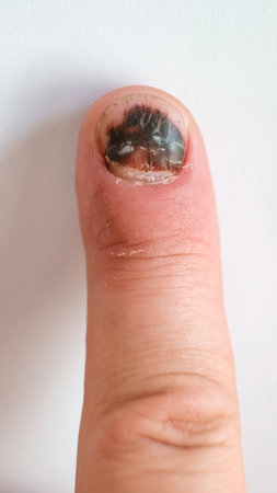 Thumb Finger with Bruised Nail, Subungual Hematoma, on White Background. Painful bruises, accident, injured fingers and medical concept. Close-up top view. Verticalの写真素材