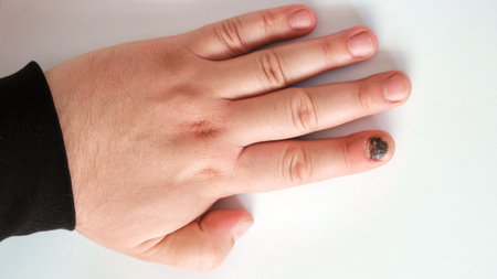 Thumb Finger with Bruised Nail, Subungual Hematoma, isolated on White Background. Painful bruises, accident, injured fingers and medical concept. Close-up top view. Ugly pain. High quality photo.の写真素材