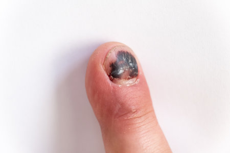 Thumb Finger with Bruised Nail, Subungual Hematoma, on White Background. Painful bruises, accident, injured fingers and medical concept. Close-up top view. High quality photo.の写真素材