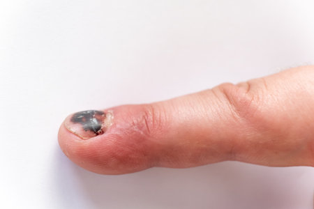 Thumb Finger with Bruised Nail, Subungual Hematoma, on White Background. Painful bruises, accident, injured fingers and medical concept. Close-up top view. High quality photo.の写真素材