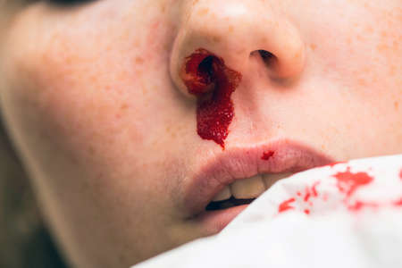 Wound nosebleed, woman bleeding from her nose, nose injury blood and tissueの写真素材