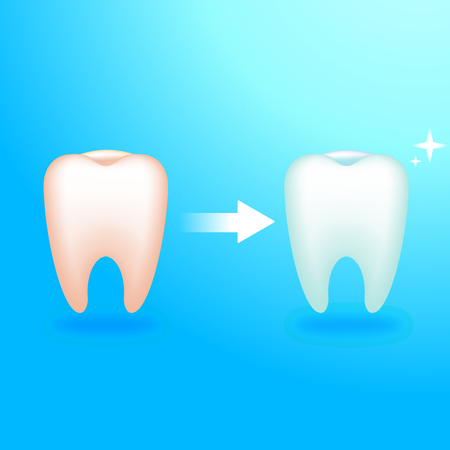 Dirty and clean tooth. Treatment at the dentist. Sore teeth. Vector realistic illustrationのイラスト素材