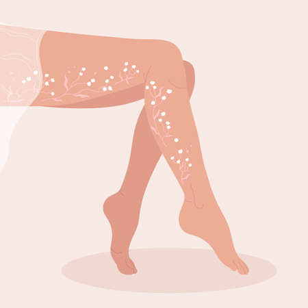Varicosity legs. Vein thrombosis and varicose treatment in the form of flowers concept. Podiatry and healthcare. Flat cartoon vector illustration isolated on white backgroundのイラスト素材