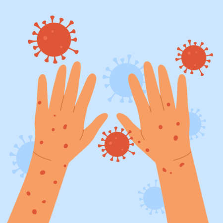 Monkeypox virus. Human hands with monkeypox. Skin infection concept. An outbreak of a smallpox pandemic. Vector illustration in cartoon style. Isolated on blue background.のイラスト素材