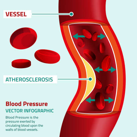 Beautiful vector illustration of blood pressure infographic. Abstract medicine concept. Useful for poster, indographics, placard, leaflet, brochure, print, book and advertisement graphic design.のイラスト素材
