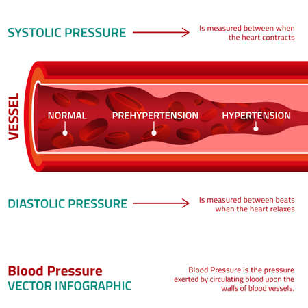 Beautiful vector illustration of blood pressure infographic. Abstract medicine concept. Useful for poster, indographics, placard, leaflet, brochure, print, book and advertisement graphic design.のイラスト素材