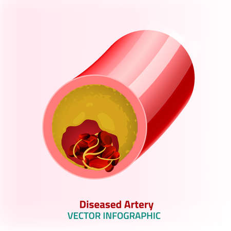 illustration of blood pressure infographic. Abstract medicine concept. Useful for poster, indographics, placard, leaflet, brochure, print, book and advertisement graphic design.のイラスト素材