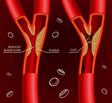 Beautiful illustration of blood flow infographic. Abstract medicine concept. Useful for poster, indographics, placard, leaflet, brochure, print, book and advertisement graphic design.のイラスト素材