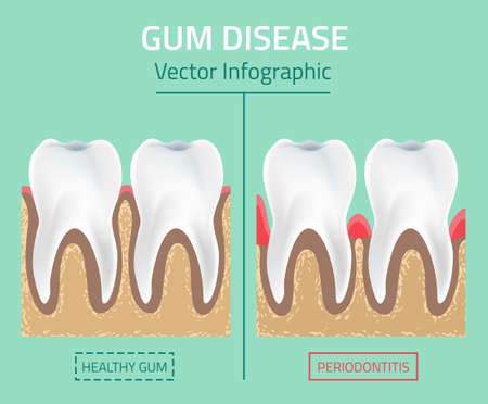 Teeth infographic. Gum disease stages. Editable illustration in modern style. Medical concept in natural colors on a light green background. Keep your teeth healthyのイラスト素材
