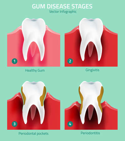 Teeth infographic. Gum disease stages. Editable vector illustration in modern style. Medical concept in natural colors on a light green background. Keep your teeth healthyのイラスト素材