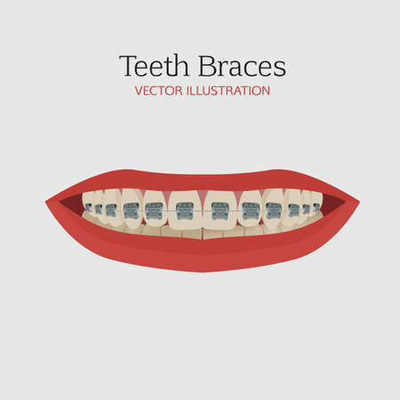 Anatomic bite concept. Medical educational image. Keep your teeth clean and healthy. Smiling female mouth with teeth and braces. Vector illustration.のイラスト素材