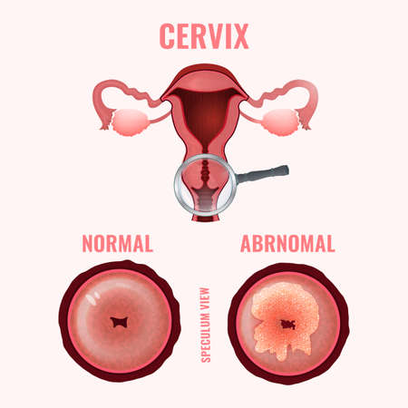 Cervical cancer development image.のイラスト素材