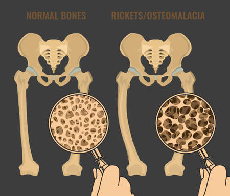 Normal bones versus Rickets and Osteomalacia. Medical, anatomy and biology concept. Educational vector illustration, isolated on a dark grey background.のイラスト素材
