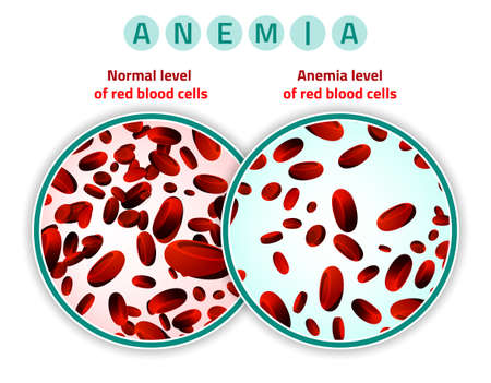 Normal level of red blood cells in comparison with iron deficiency anemia level. Medical and healthcare concept. Vector illustration isolated on a white background.のイラスト素材
