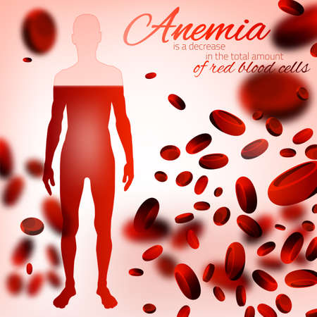 Red blood cells background. Iron deficiency anemia image. Medical and healthcare concept with a human figure in pink and red colors. Editable vector illustration.のイラスト素材