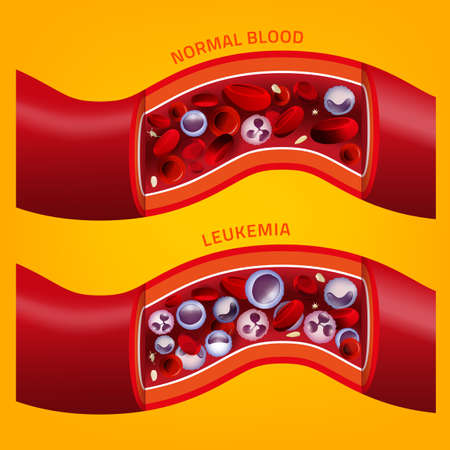 Leukemia and normal blood vessel in comparison. Medical infographic. Editable vector illustration isolated on orange background. Scientific and educaional concept. Square poster.のイラスト素材