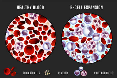 Leukemia and normal blood under the microscope in comparison. Medical infographic. Editable vector...