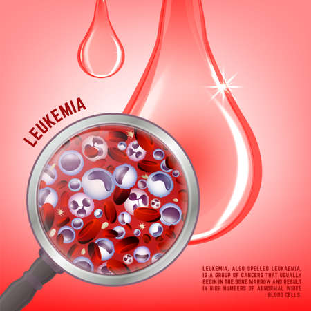 Leukemia vertical background in bright colors. White and red blood cells in realistic style. Leukaemia disease awareness. Editable vector illustration. Medical, scientific and healthcare poster.のイラスト素材