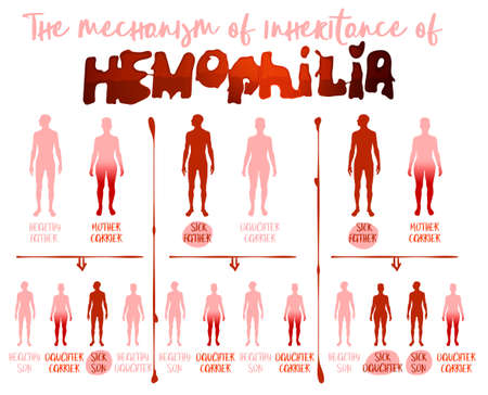 Hemophlia infographic facts. Editable vector illustration in red and pink colors isolated on white background. Medical, healthcare and scientific concept with useful inheritance data. Landscape posterのイラスト素材