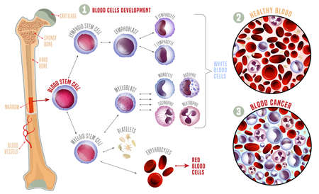 Leukemia and normal blood under the microscope in comparison. Medical infographic. Blood cells production scheme. Vector illustration on a white background. Scientific concept. Horizontal poster.のイラスト素材