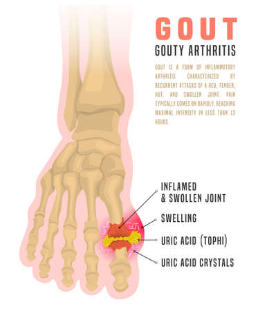 Gout arthritis infographicのイラスト素材