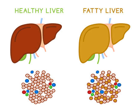 Healthy and fatty liver. Medical vector infographic.のイラスト素材