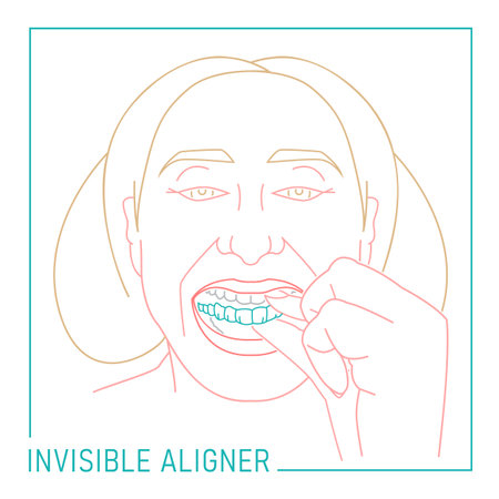 Orthodontic silicone trainer. Invisible braces aligner, retainer.のイラスト素材