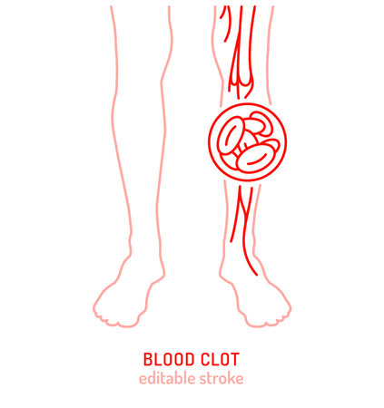 Blood clot in leg vein vector icon, medical pictogram for vascular disease awarenessのイラスト素材