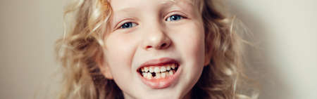 Closeup of smiling Caucasian blonde girl showing her missing lost milk tooth. Dental oral health hygiene. Stage of kids growing up adolescense. Happy authentic childhood. Web banner or header.の写真素材