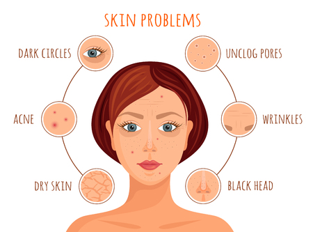 Types of skin problems. Vector illustration. Information banner on the skin care. A woman's face with examples of skin problems.のイラスト素材