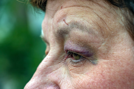 A human eye with a large black-violet bruise. Swelling due to bruise.