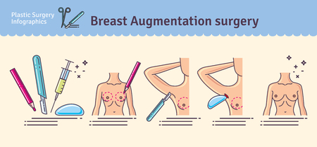 Illustrated set with breast augmentation surgery. Infographics with icons of plastic surgery procedures.のイラスト素材