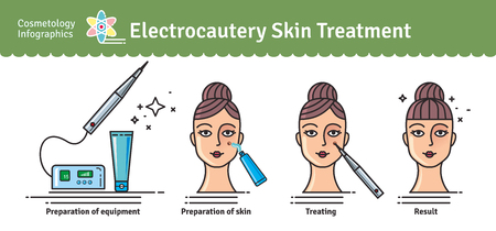 Vector Illustrated set with salon cosmetology electrocautery skin treatment. Infographics with icons of medical cosmetic procedures for skin.のイラスト素材