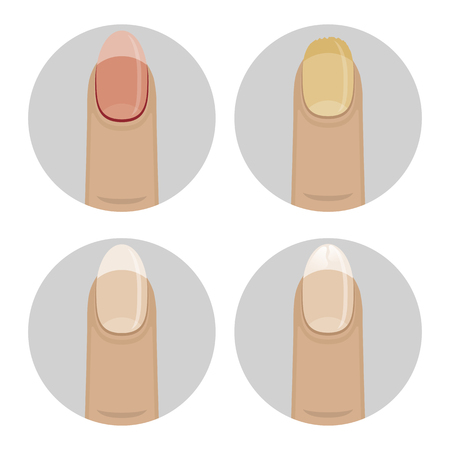 Set of icons with nail diseases. Women affected by fungus nails, brittle, sick.のイラスト素材