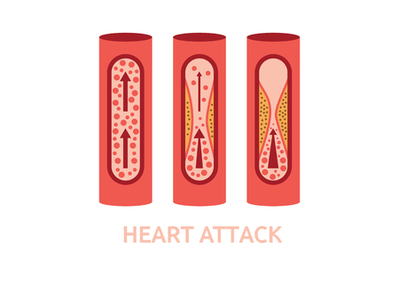 heart attack symptoms arteries disease medicine healthcare illustrationのイラスト素材