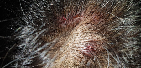 Scabs On The Scalp, wound on the scalps or Lichen planus follicularis capillitii, itch on the...