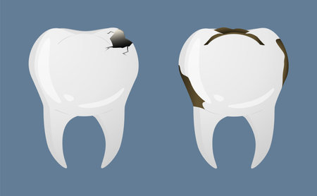 Teeth in realistic style. Teeth decay icons. Colorful vector illustration isolated on background.のイラスト素材