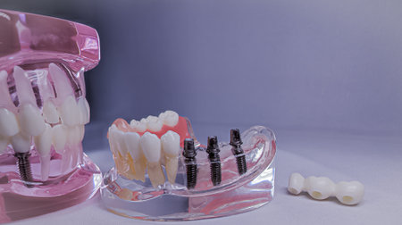 Mandibular Implant Model with Fixed Bridge Prosthesisの写真素材