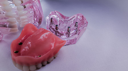 Fixed Full Arch Implant Prosthesis with Maxillary Implant Model and Transparent Occlusion Modelの写真素材