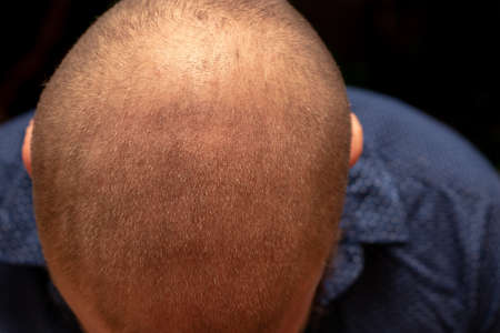 Top down view of a man's bald head, receeded hairline. Isolated on black backgroundの写真素材