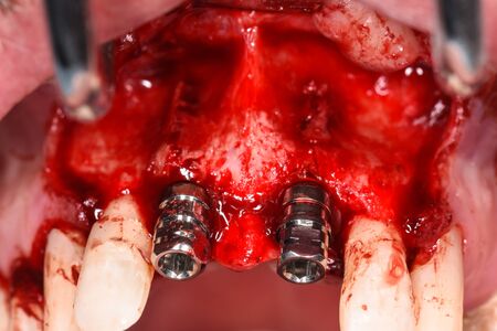 Horizontal color image with a low angle view of an adults upper central incisor teeth surgery implants (Teeth number 11 and 21)の写真素材