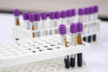 Milan, Italy - November 18, 2020: Sorting of blood tubes in a rack in the analysis laboratoryのeditorial素材