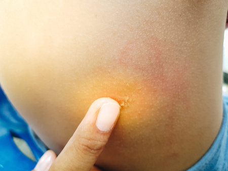 Treating itching From mosquito bites