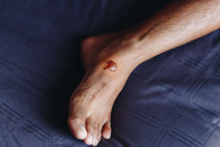 The scald on the foot skin caused by the boiling cooking oil .blisters on the feetの写真素材